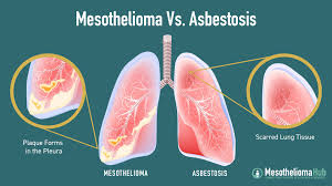 The Greatest Risk Factors for Mesothelioma